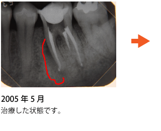 歯の神経の治療 症例