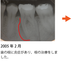 歯の神経の治療 症例