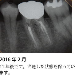 歯の神経の治療 症例