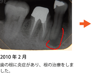 歯の神経の治療 症例