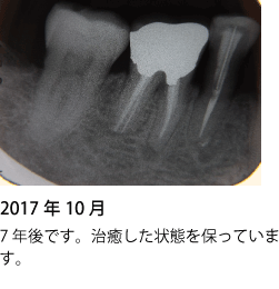 歯の神経の治療 症例