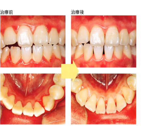 周 治療 歯 病 歯周病専門医が行っている最新治療法と一般歯科との治療の違い