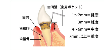 歯周病の治療