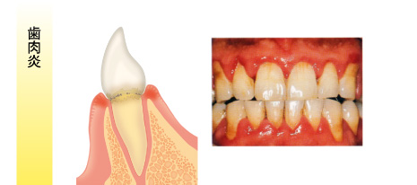 歯周病の治療