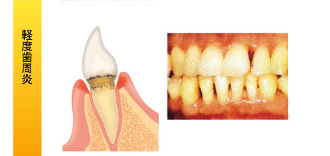 歯周病の治療