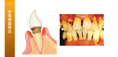 歯周病の治療