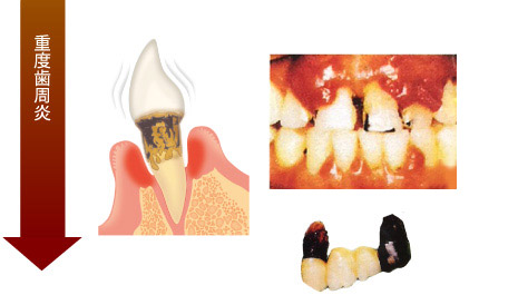 歯周病の治療